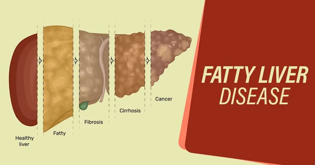 Fatty Liver Disease (Hepatic Steatosis)