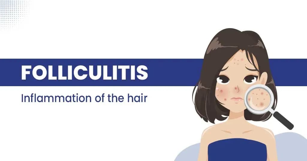 Folliculitis - Symptoms, causes and treatment