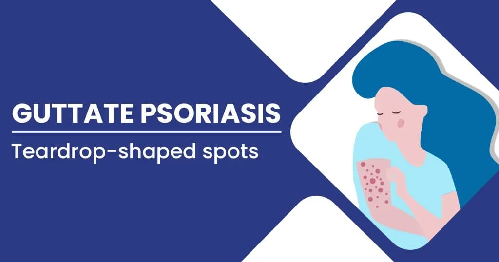 Guttate Psoriasis – Causes, Stages, Diagnosis, Treatments and more