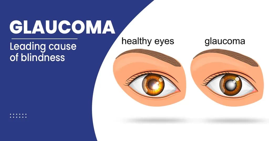 Glaucoma 