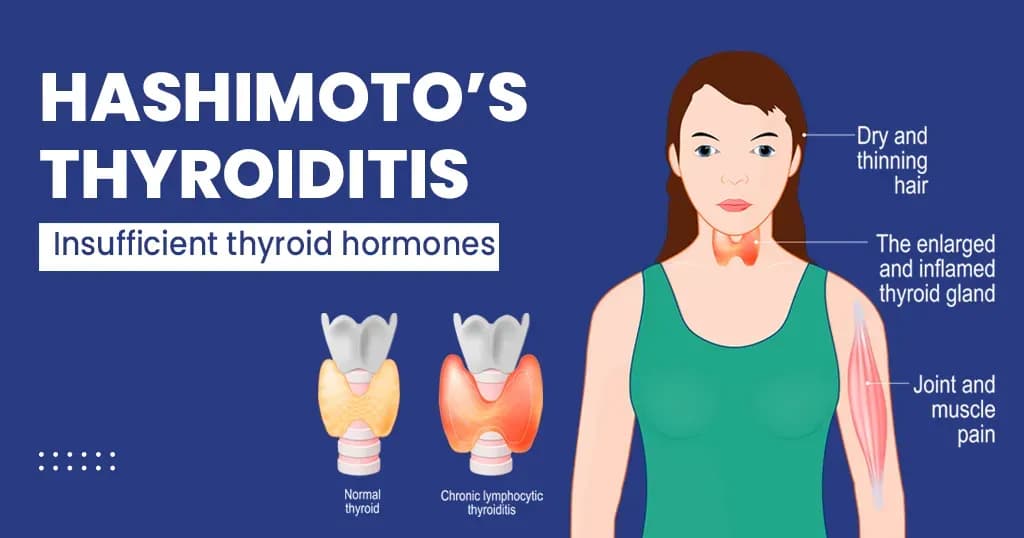 Hashimoto's thyroiditis – Causes, Symptoms, Diagnosis and Treatment