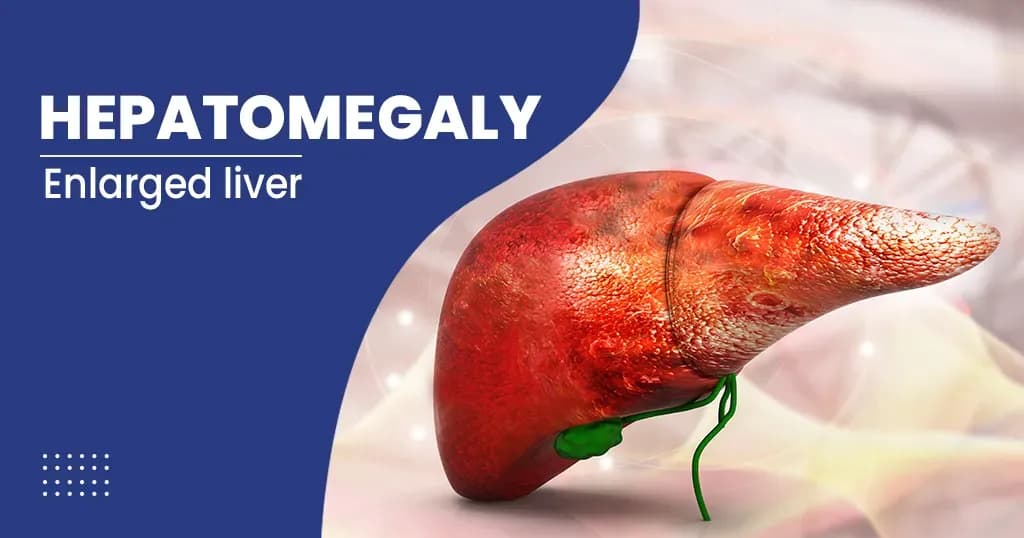 Hepatomegaly (Fatty Liver) – Causes, Symptoms and Treatments