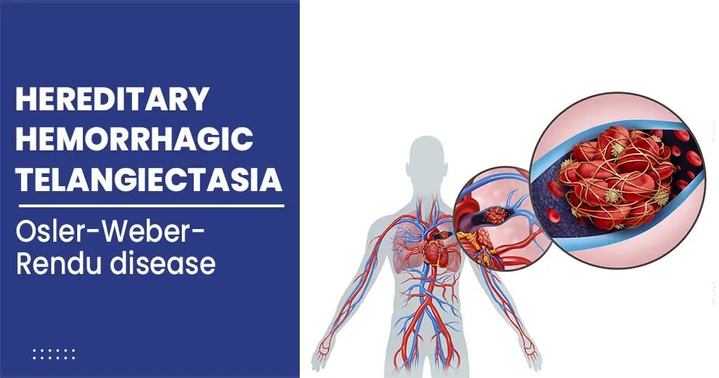 Hereditary hemorrhagic telangiectasia - Symptoms and Treatments