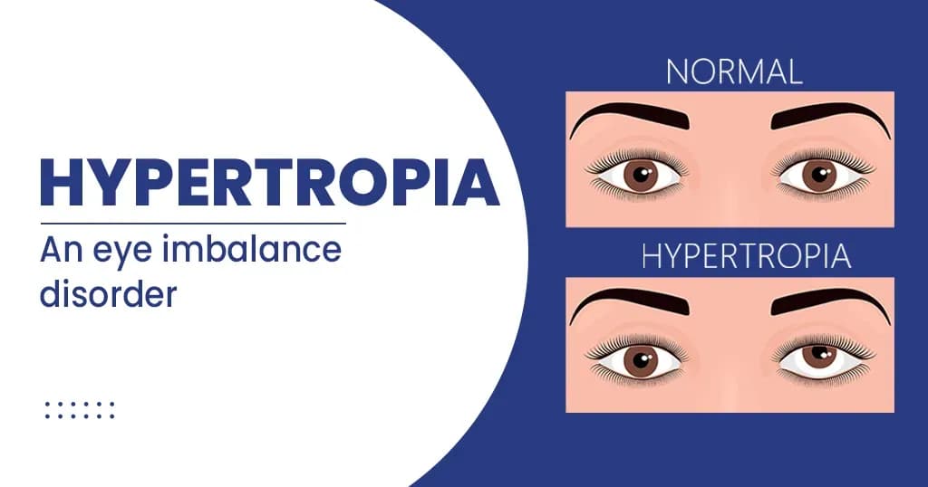 Hypertropia Causes, Symptoms, Risk factors and more