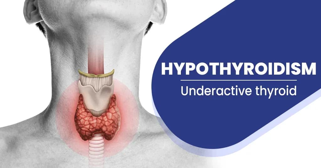 Hypothyroidism - Causes , Symptoms, Treatments, and More