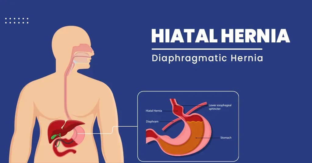 Hiatal hernia - Types, Symptoms, Diagnosis, and Treatment