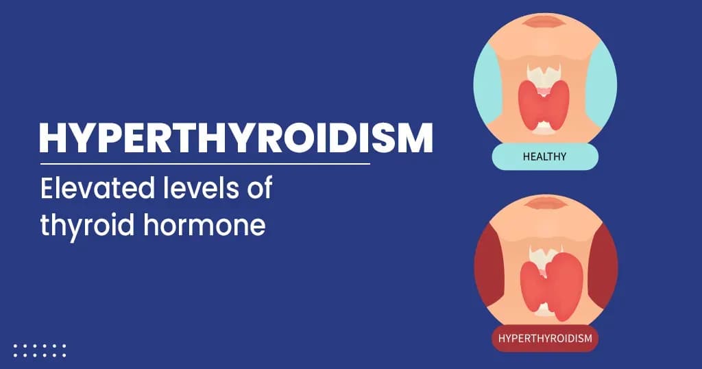 Hyperthyroidism – Causes, Symptoms, Diagnosis, and Treatments