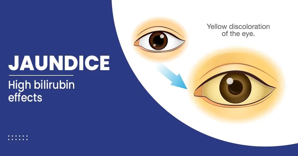 Jaundice  – Types, Symptoms, Treatments and Prevention