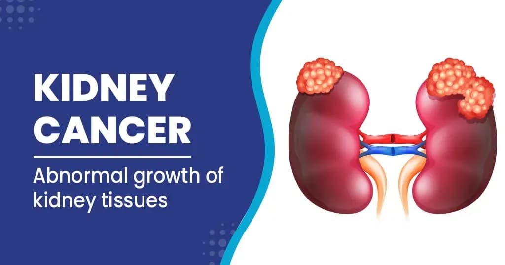 Kidney cancer: Causes, risk factors and treatments