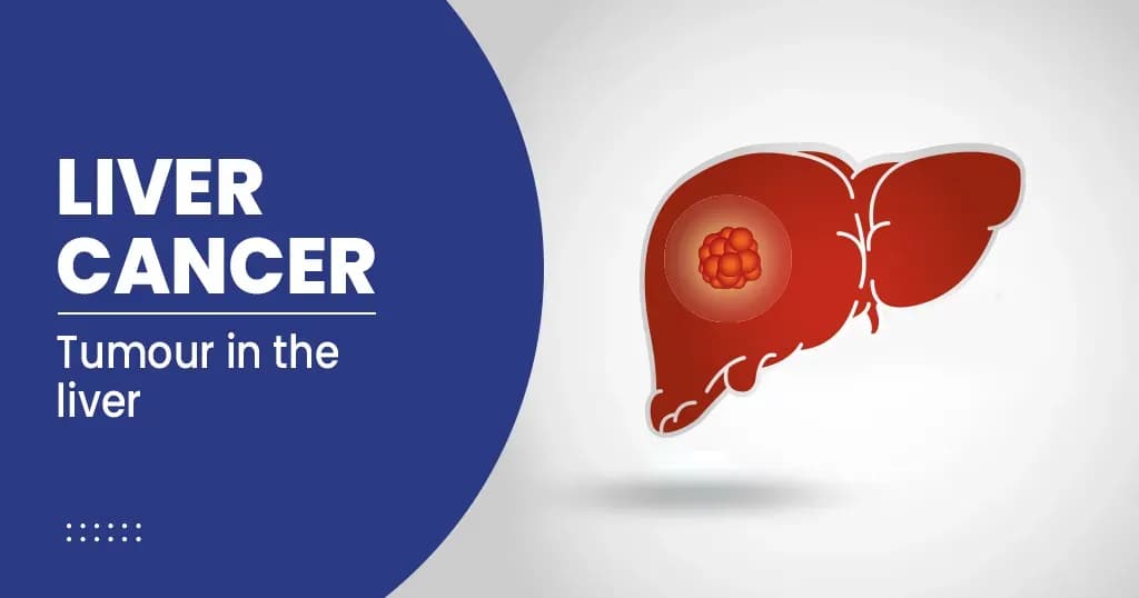 Liver cancer-causes-symptoms-risk-factors-and-prevention