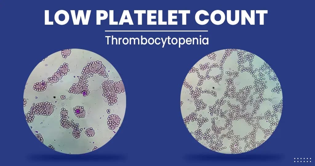 Low platelet count - Symptoms , Diagnosis, Treatment, and More