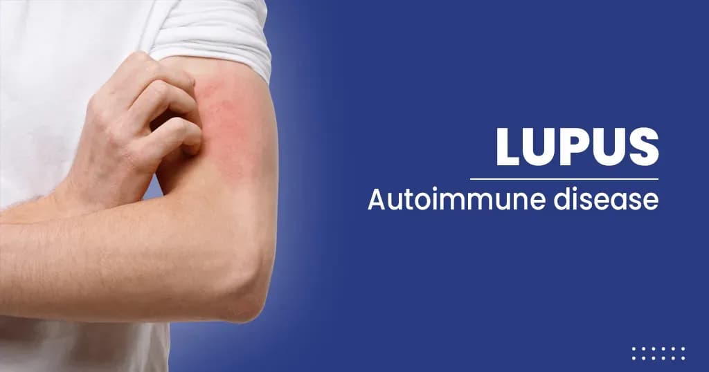 Lupus – Types, Causes, and Risk factors