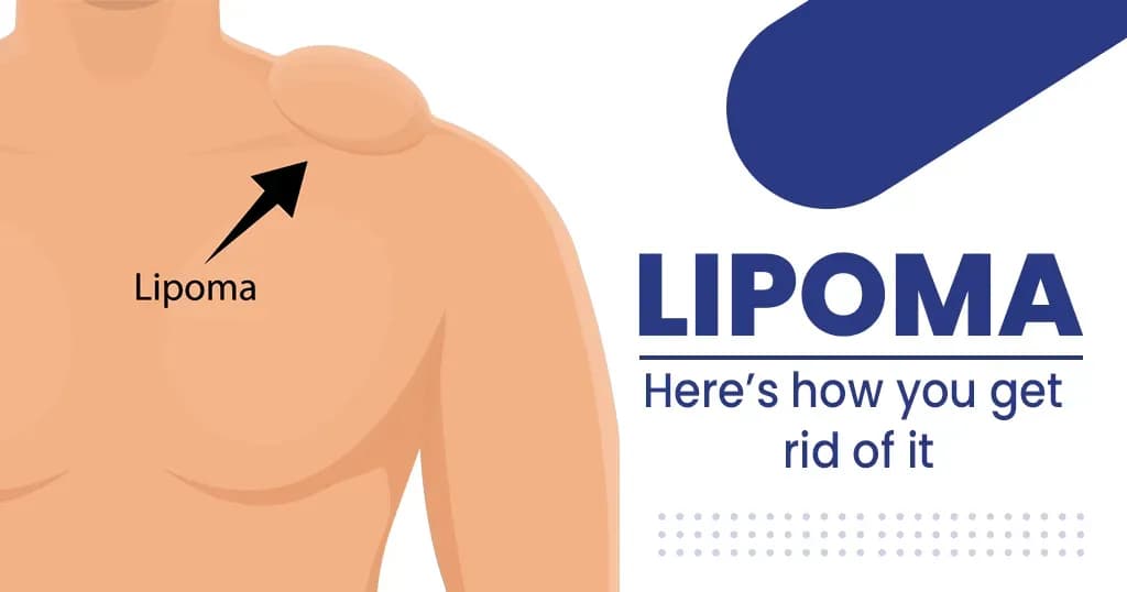 Lipoma: Causes, symptoms, diagnosis and removal