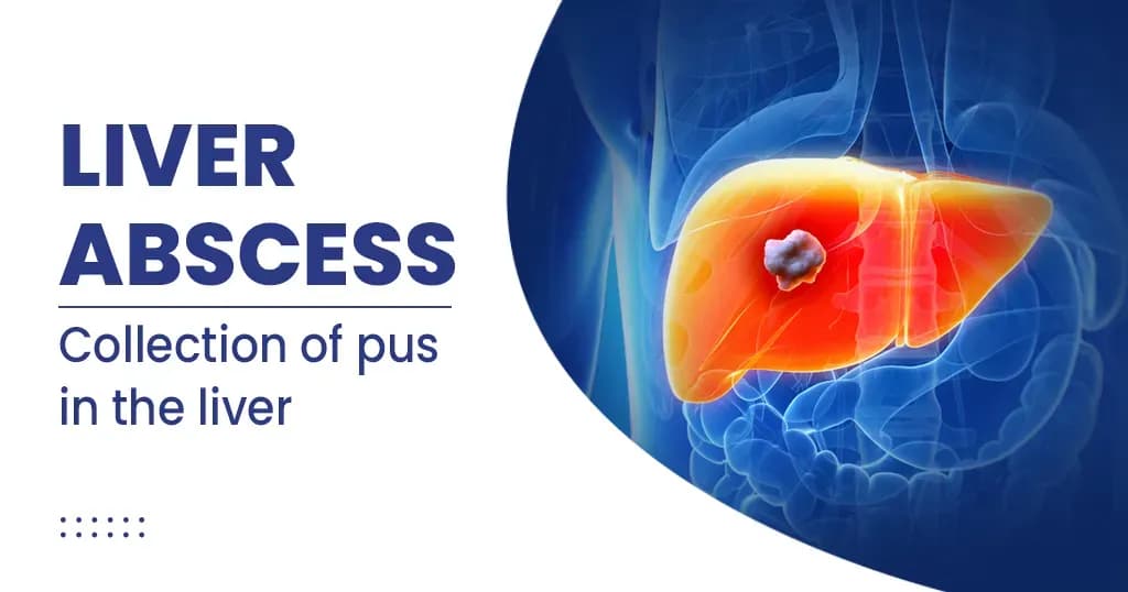 Liver abscess - Causes, Symptoms, Diagnosis and Treatment