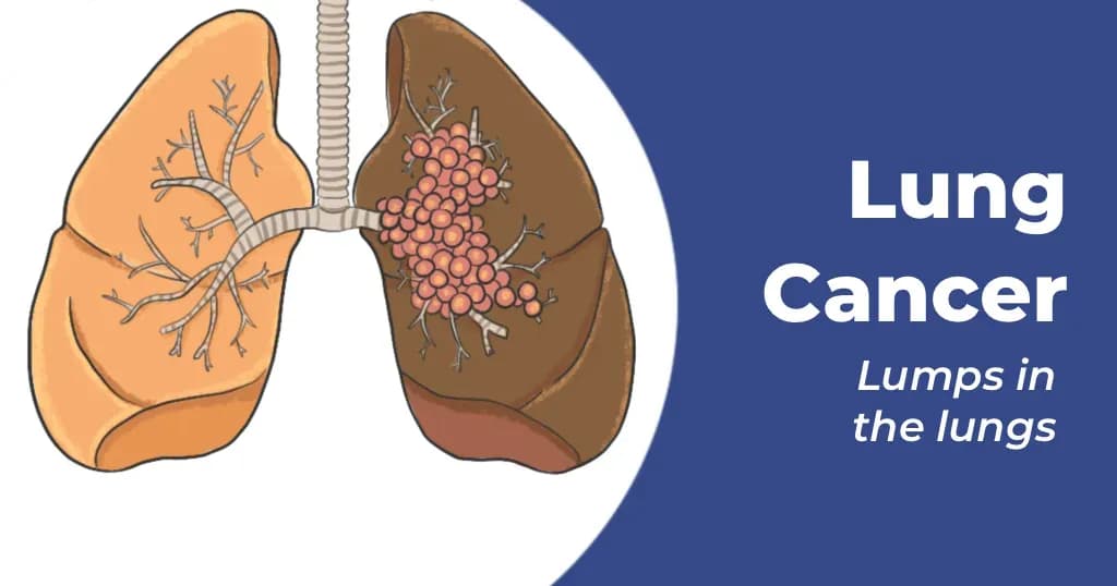 Lung cancer: Symptoms, signs and stages