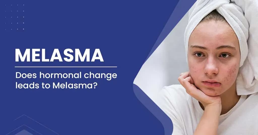 Melasma causes symptoms & treatment