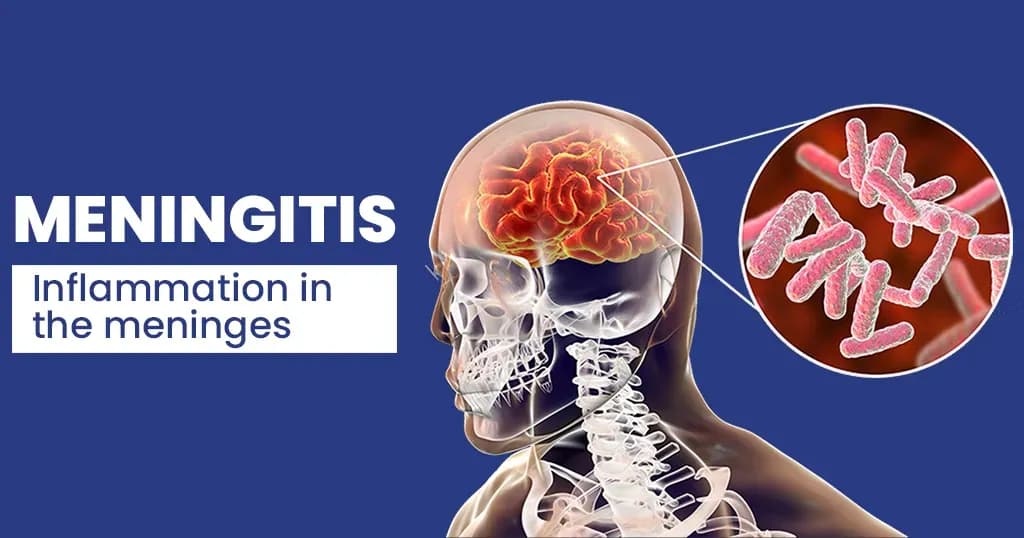 What is meningitis- Types, Symptoms, and Risk factors