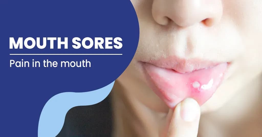 Mouth sores - Symptoms and Causes