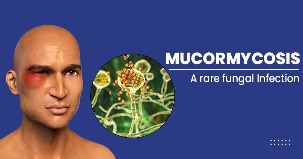 Mucormycosis(Black fungus) - Causes and symptoms