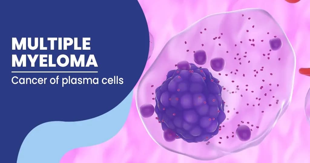 Multiple myeloma- Causes, Treatments