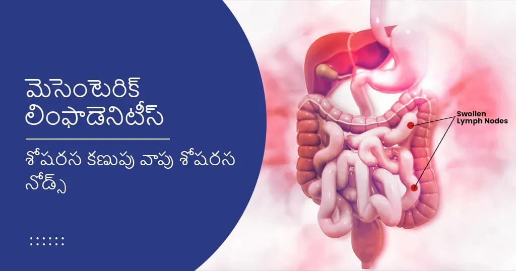 మెసెంటెరిక్ లింఫాడెనిటీస్-లక్షణాలు, కారణాలు మరియు చికిత్స