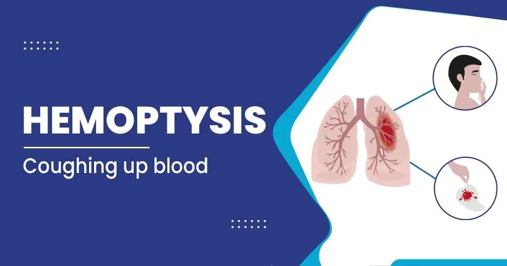  Hemoptysis - diagnosis and treatment