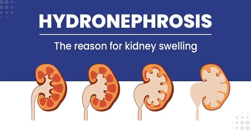 Hydronephrosis - causes, symptoms, and treatments