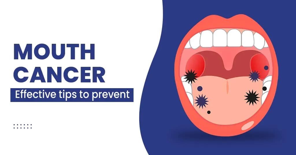 Mouth cancer - Symptoms, Stages, Risk factors, Treatments and more