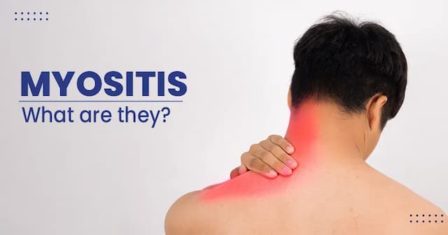 Myositis – Types, Causes, Diagnosis, and Treatments