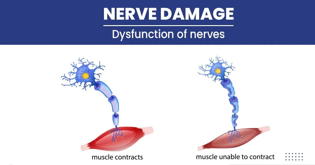 Nerve damage – Types, Symptoms, Causes, and Treatments