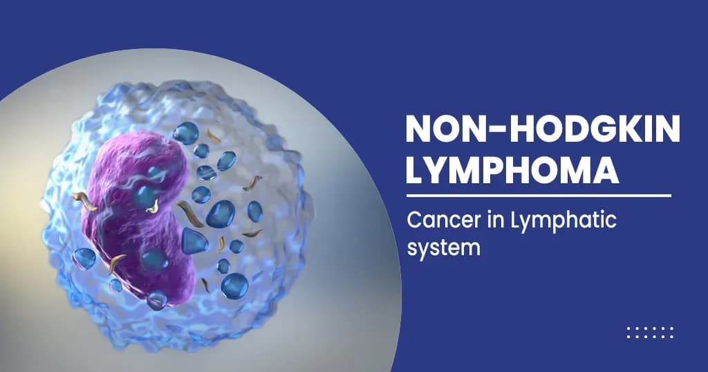 Non-Hodgkin's lymphoma – What Is It? Symptoms, Causes, Treatment, And Preventions