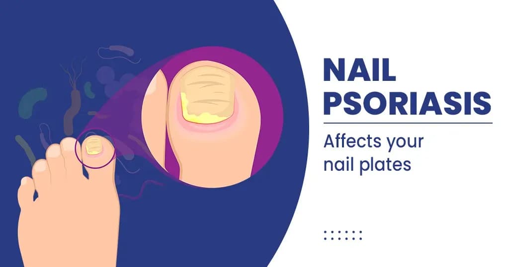 Nail Psoriasis – Causes, Symptoms and Treatments