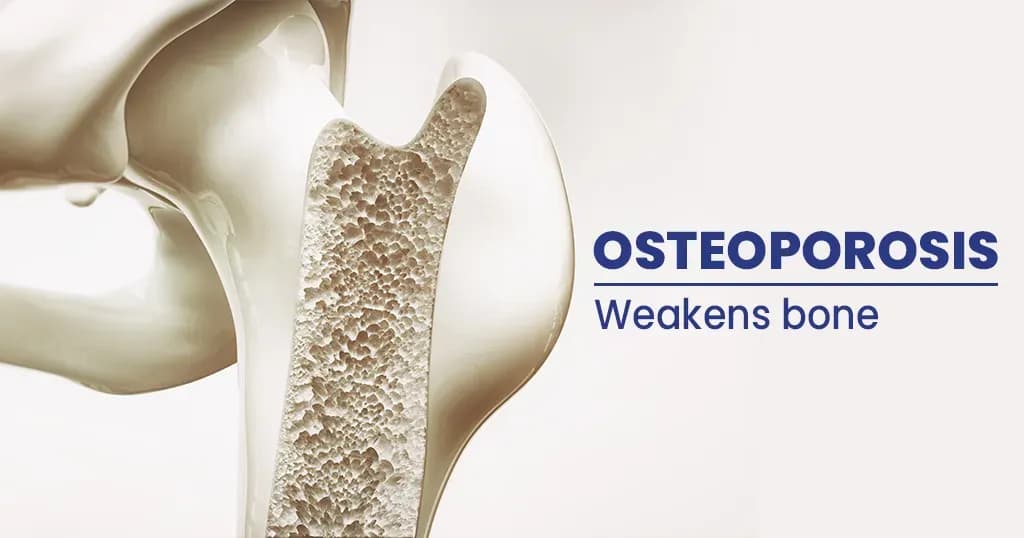 Osteoporosis - Causes, Symptoms, Risk Factors, and Treatments