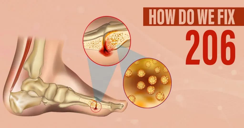 Bone Infection (Osteomyelitis): Symptoms and Treatment