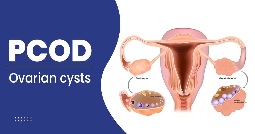 PCOD Symptoms -  Check PCOD Causes and treatment here