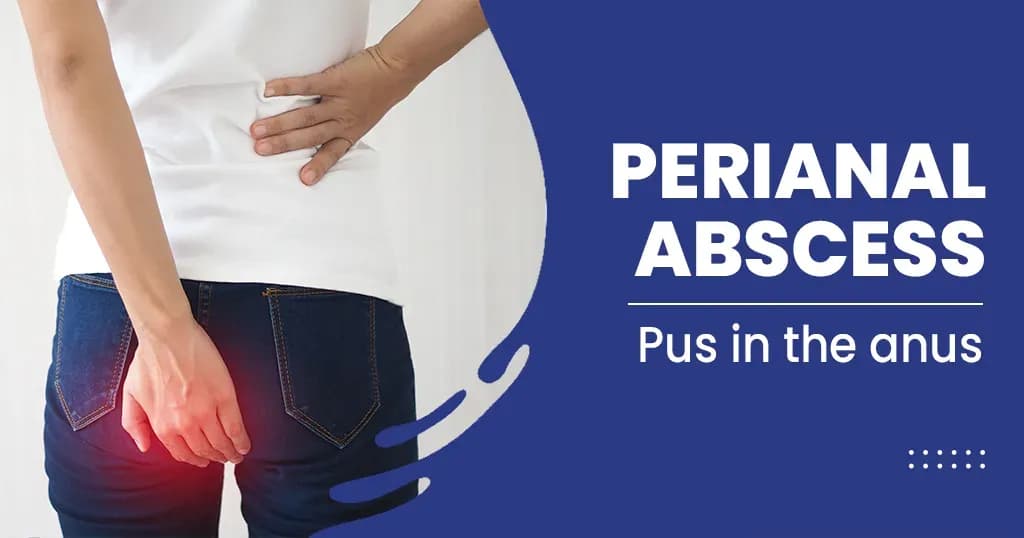 Perianal abscess – Causes, Symptoms, Risk factors, and Treatments