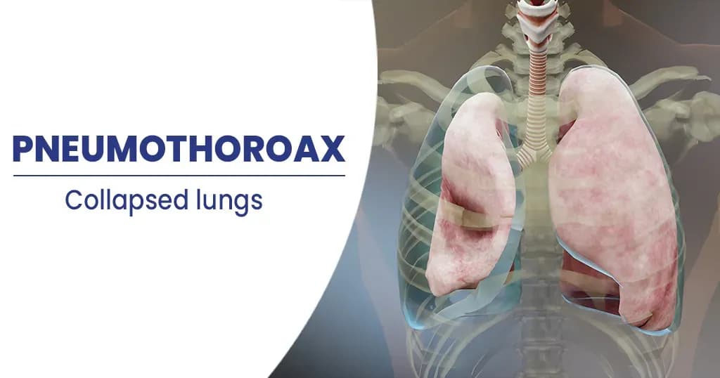 Pneumothorax- Types, Symptoms, and More