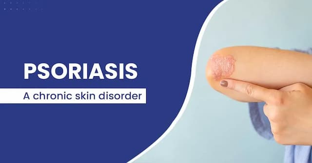 Psoriasis - Causes, symptoms, types and treatments