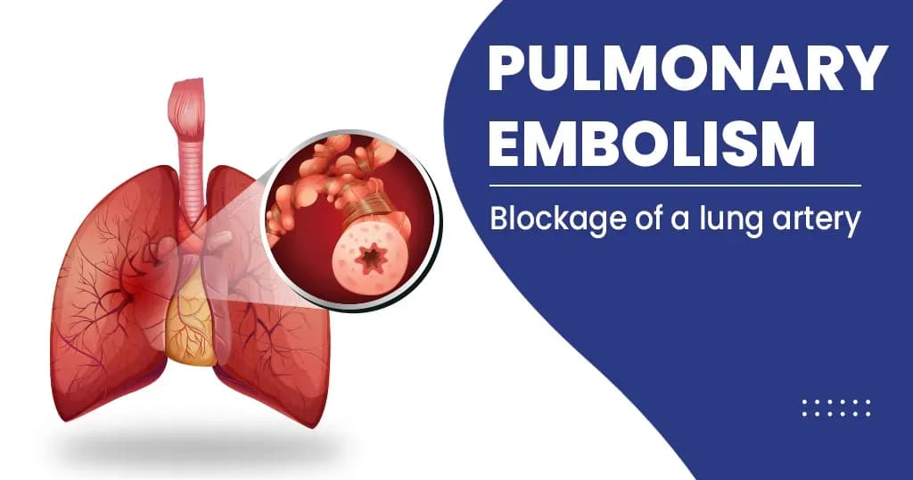 Pulmonary Embolism - Causes , Symptoms , Risk Factors, and More