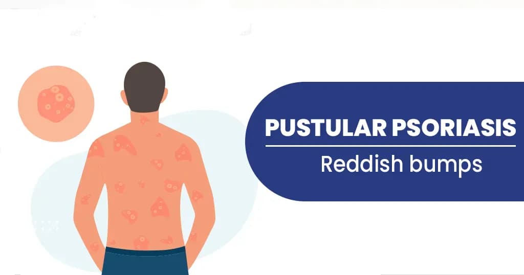 What is Pustular Psoriasis? - Types and Treatments