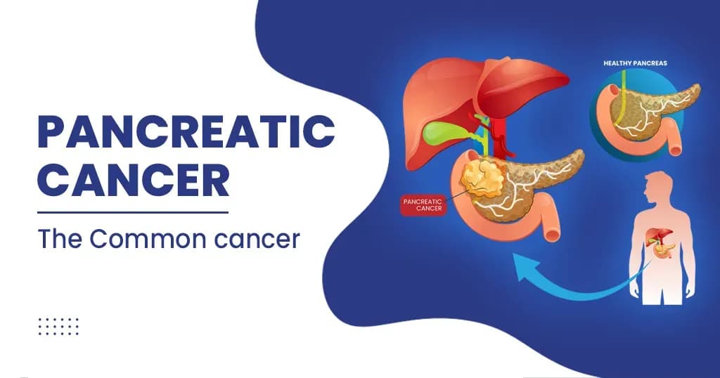 Pancreatic cancer - Causes, symptoms and treatment