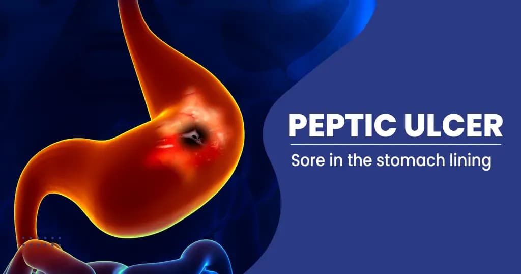 Peptic Ulcer Disease - Causes, Symptoms, Treatment , And Preventions  