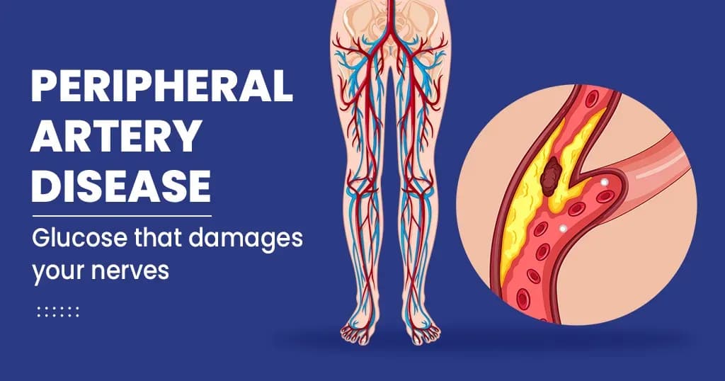 Peripheral Artery Diseases  - Risk, Symptoms, Diagnosis and Treatment