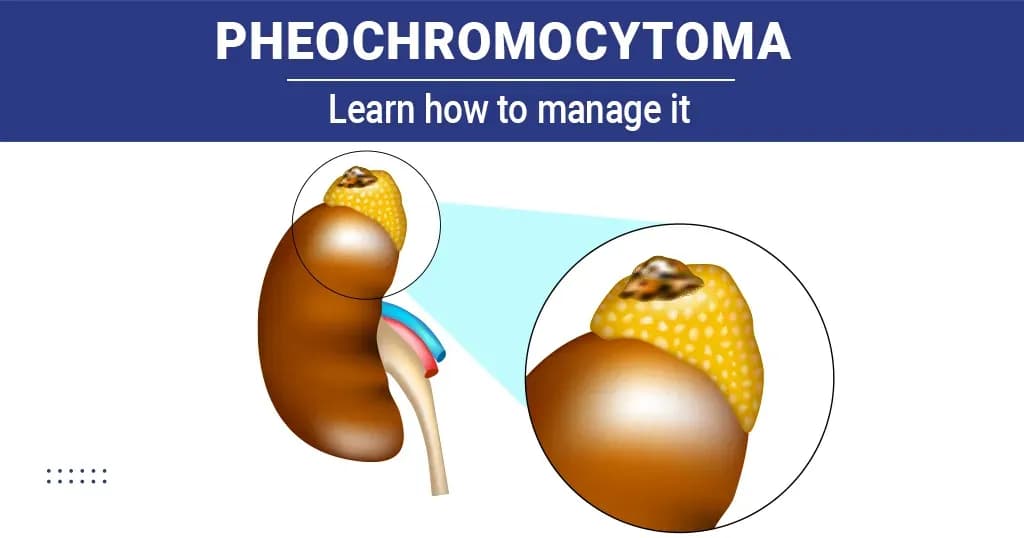 Pheochromocytoma – Stages, symptoms, and causes