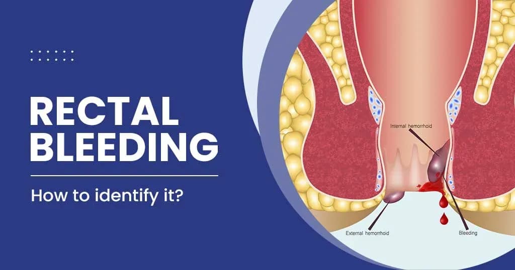 Rectal bleeding (Blood in Stool) - Symptoms, causes and treatment