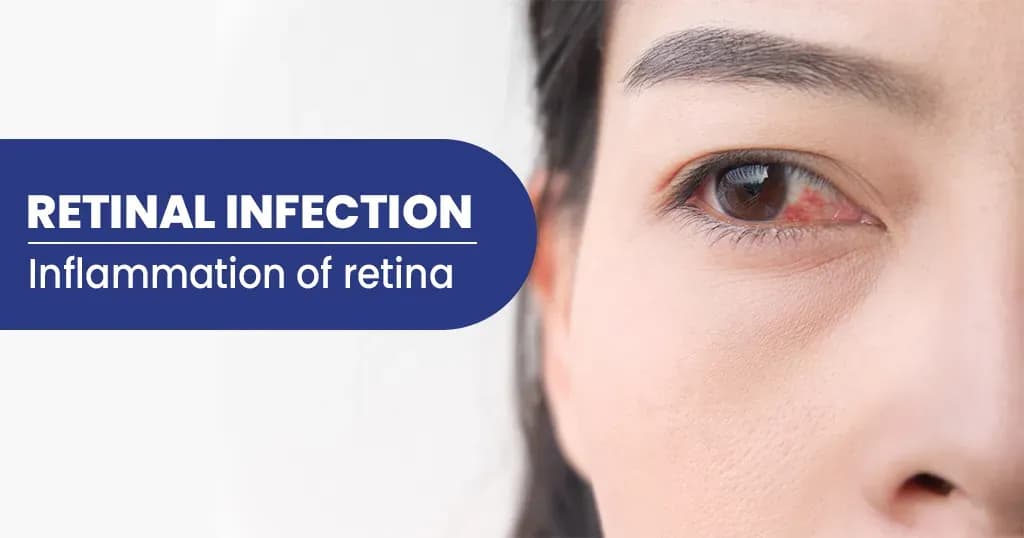 Retinal infection - Types, Symptoms, Risk factors, and Treatments