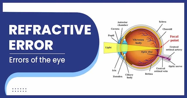 Refractive errors