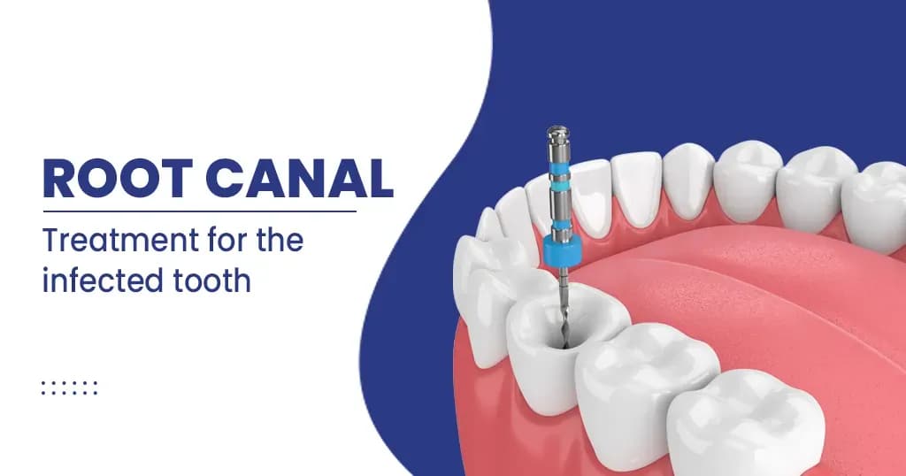 Root Canal - Procedure and Guidelines