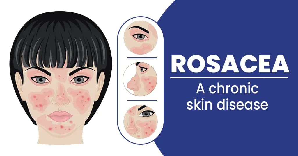 Rosacea—Causes, types, symptoms and treatments