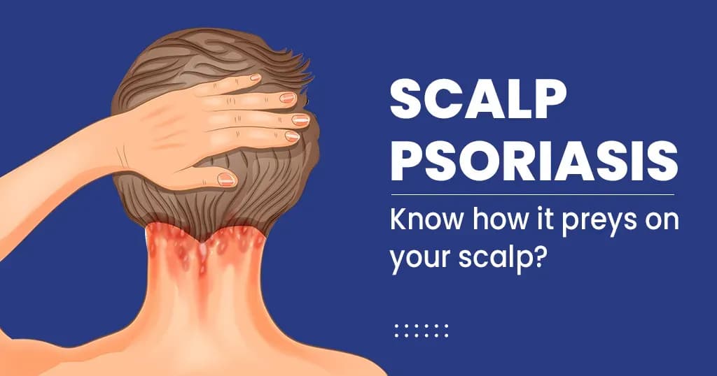 Home remedies for Scalp Psoriasis